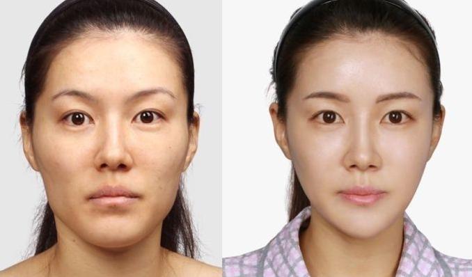 颧骨高适合磨骨还是填充,太阳穴凹陷颧骨突出磨骨