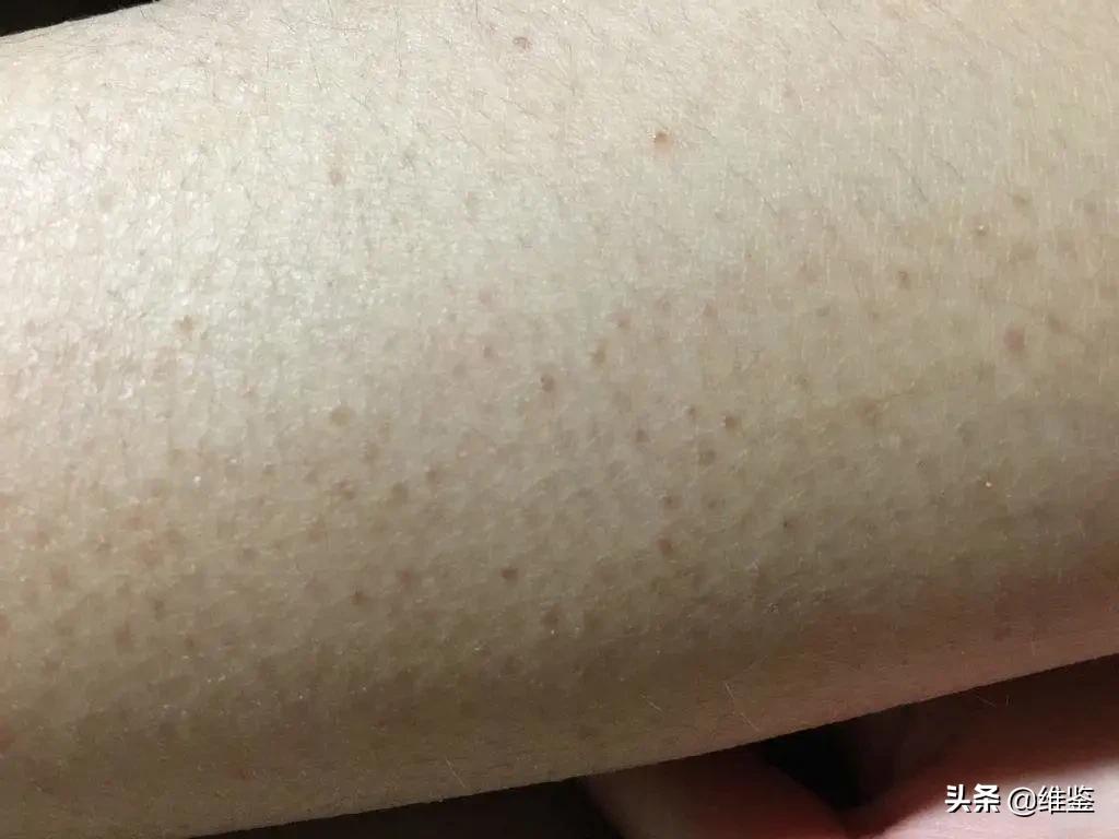 鸡皮肤怎么改造好看,鸡皮肤真难看到底应该怎么办