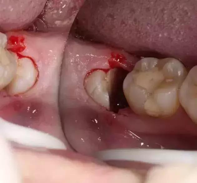 有人拔牙收100块，有人却收1000块！