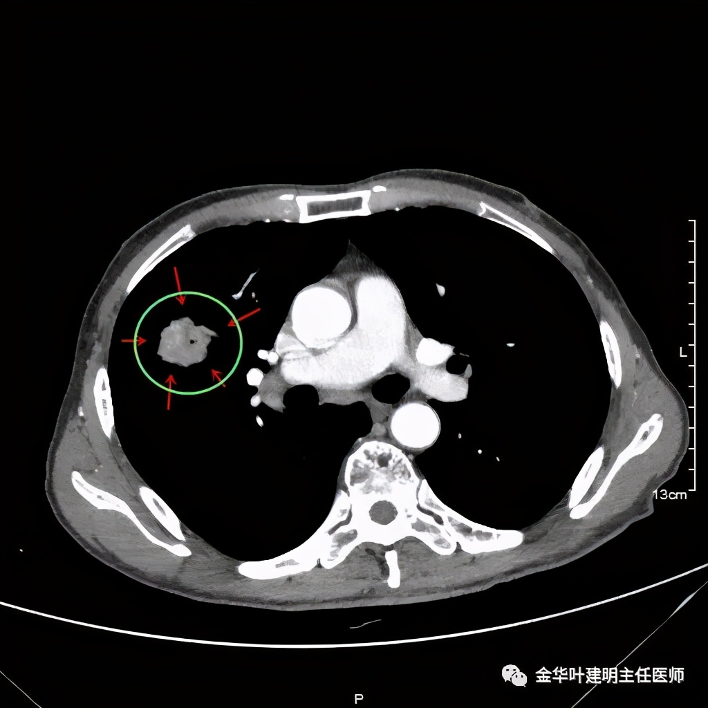 得了肺癌做肺部穿刺有影响吗,肺部穿刺可以确诊肺癌吗