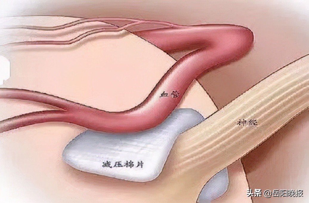 突破！岳阳市中心医院神经外科改良粗大椎动脉压迫面神经悬吊术