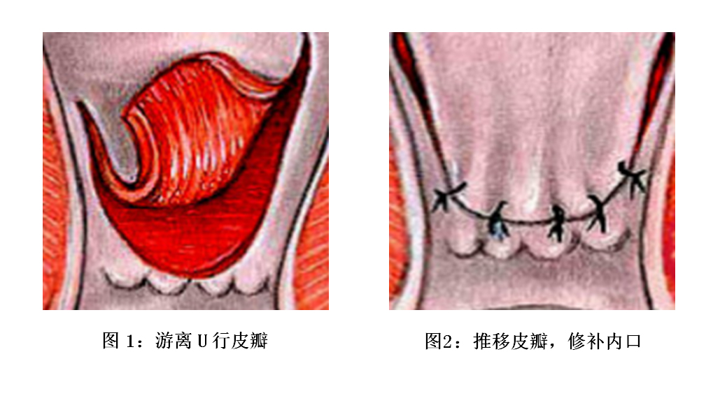 高位复杂性肛瘘最好的治疗方法,高位复杂性肛瘘不痛不痒不流脓
