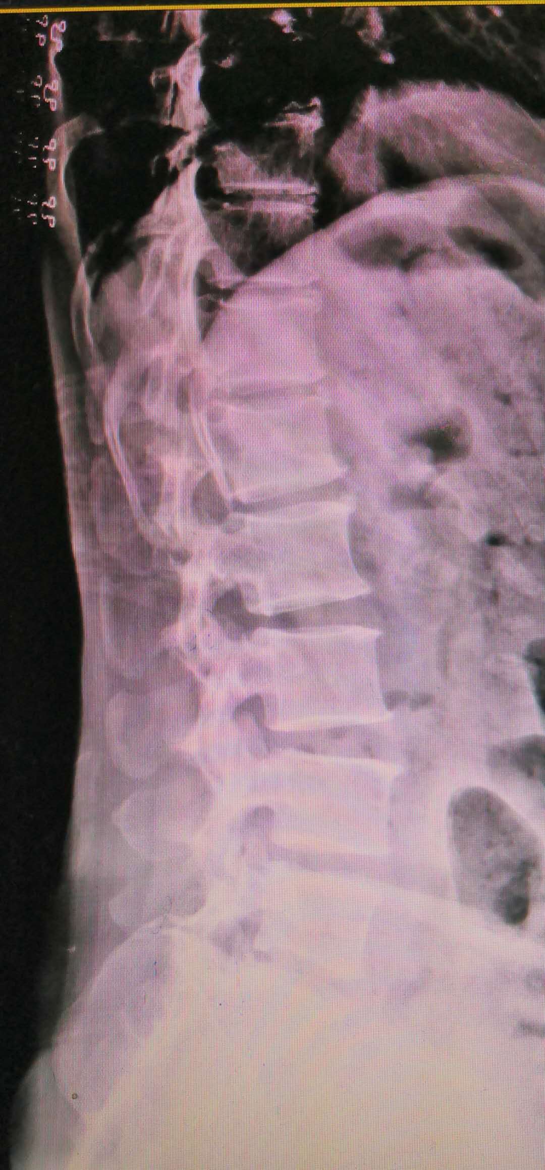 腰椎滑脱做开放手术需要多少费用,腰椎滑脱微创和开放手术哪个好