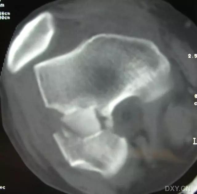 几种严重骨折医学名称,常见的骨折有哪些名称