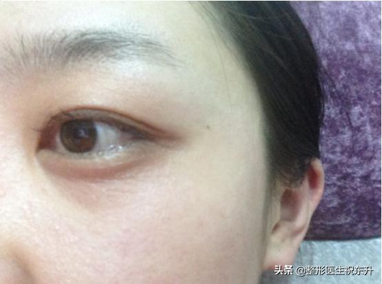 下眼皮松弛没有眼袋能外切吗,眼睛痒干能不能做切眼袋手术