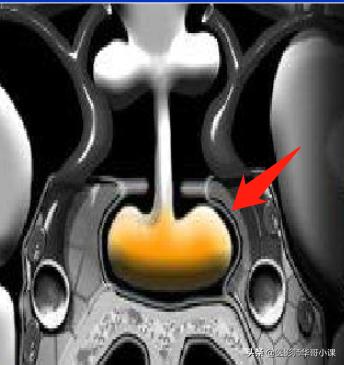 12岁垂体偏小是生长激素缺乏吗,儿童脑垂体偏小与生长激素的关系