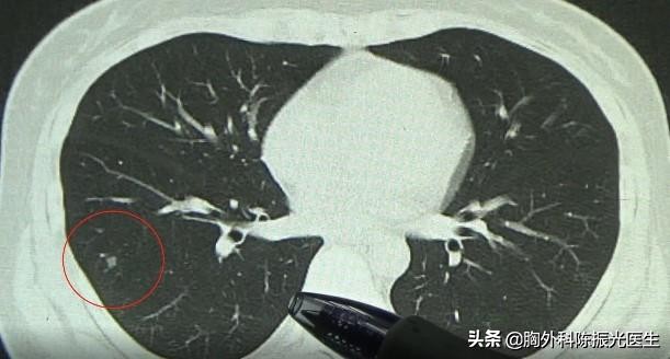 肺结节：半实性隐约有血管穿入、磨砂玻璃有条索影，该怎么办？