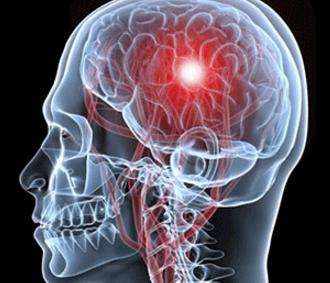 干细胞治脑出血后遗症新进展,303医院干细胞治疗脑出血后遗症