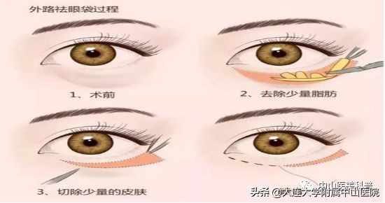 你有没有被自己的眼袋困扰过,关于眼袋的科普在这里