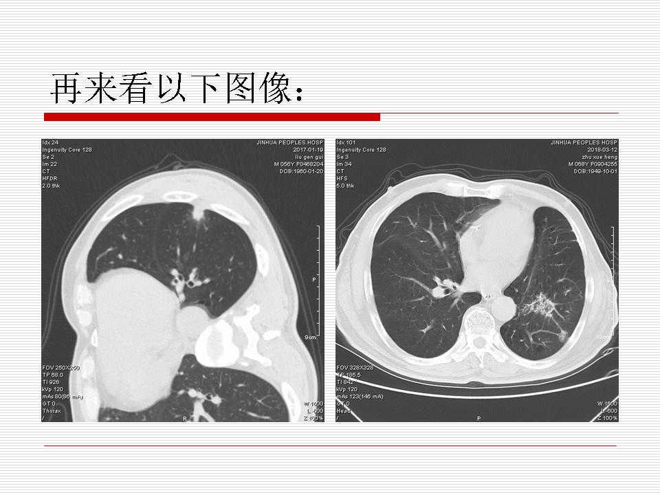 像炎症的肺癌能治好吗,医生说可能是肺癌也可能是炎症