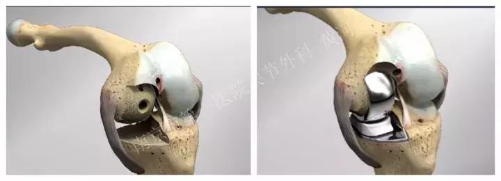 关于膝关节疼痛你一定有好多疑问,关于膝盖疼痛的疑问