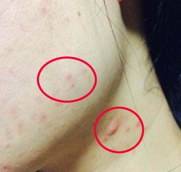 真人体验美容院,光子嫩肤美容院真实体验