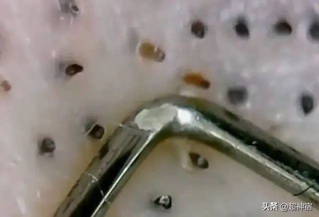 教你5个根治闭口粉刺方法,闭口痘痘彻底根治