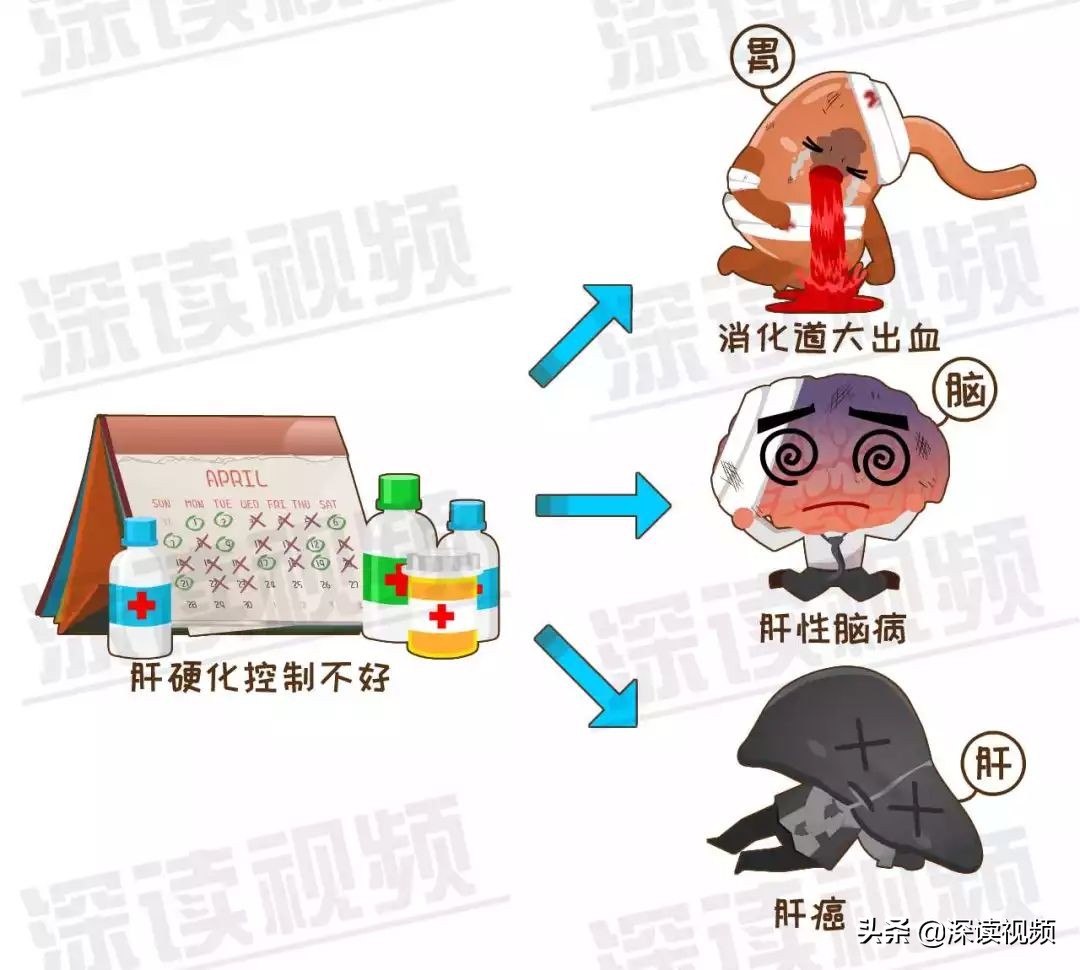 肝硬化70,肝硬化7.75严重吗
