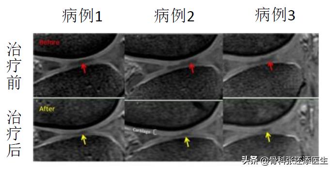 治疗膝关节痛的特效药氨糖,膝关节疼痛特效药偏方视频