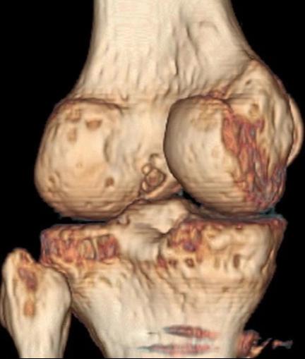 关节手术后康复训练弯不了怎么办,手术关节僵硬三个月了可以恢复吗