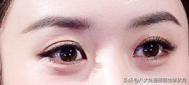 双眼皮刚做完很好看越恢复越难看,双眼皮做完感觉自己睁眼睛不自然