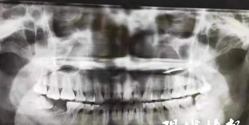 智齿发炎持续1个月怎么处理,智齿破了一个洞老是发炎