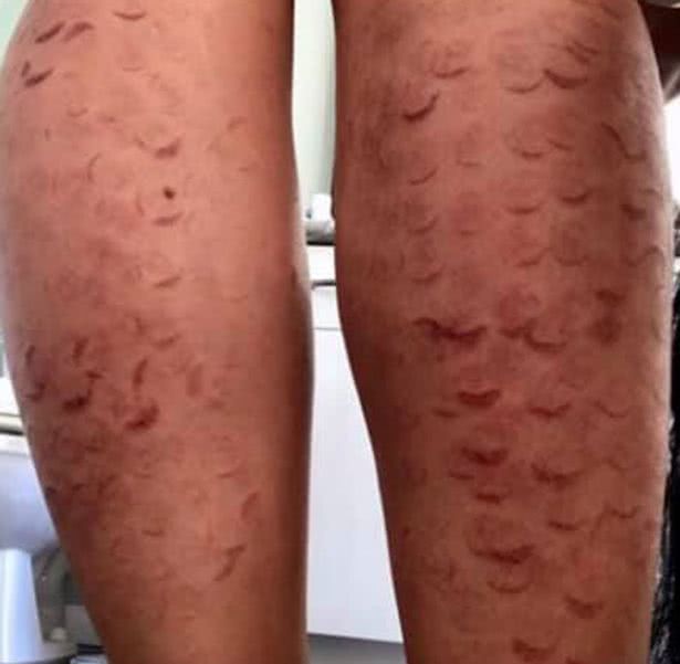 温哥华妹子花7000加币激光脱毛,加拿大女子被烧伤