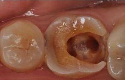 被牙痛折磨的痛苦你真的无法体会,牙医都不会告诉你的牙疼方法