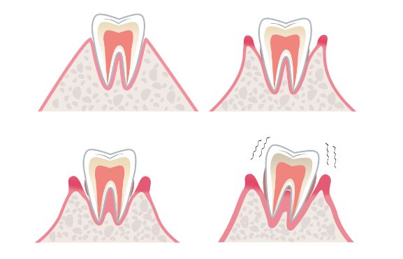 牙齿黑三角区怎么办,牙齿黑三角怎么改善