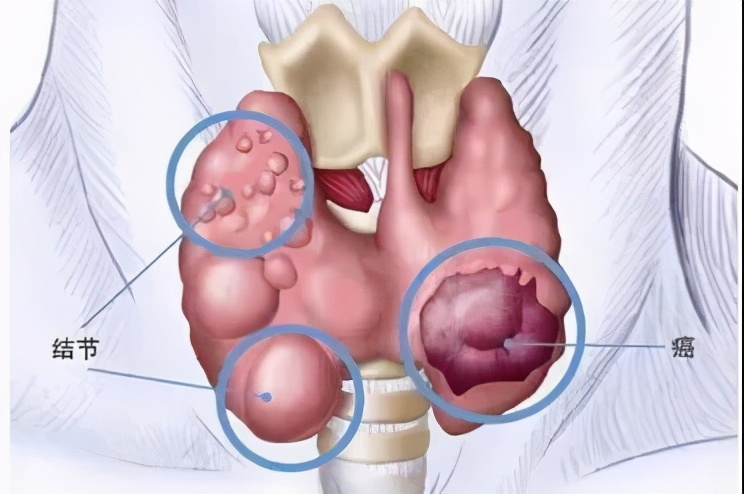 甲状腺结节癌手术后最忌讳什么,甲癌术后发现多发肺结节要观察吗