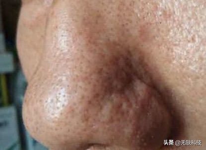 不管黑头的后果,不管黑头行吗