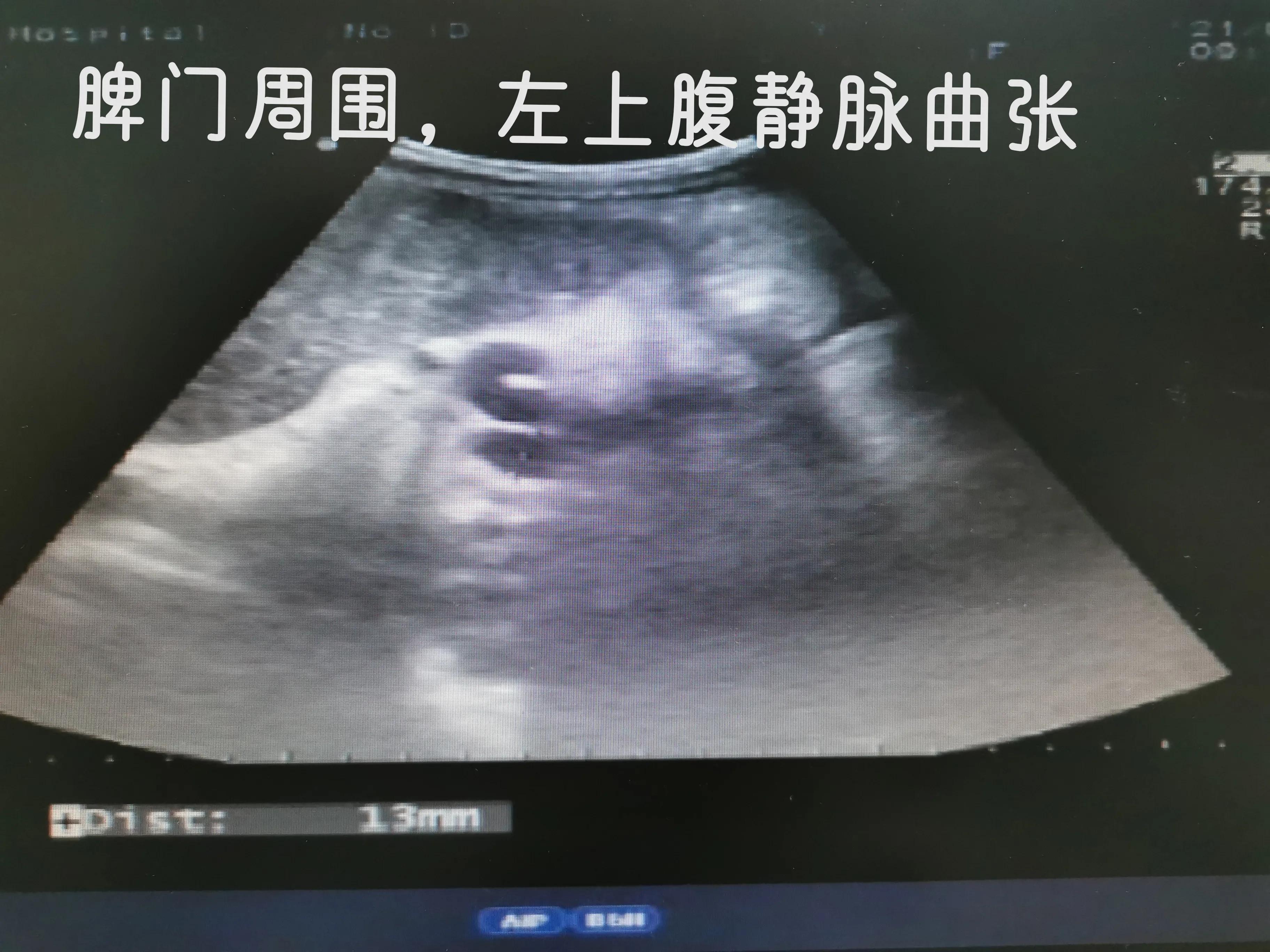 乙肝肝硬化和丙肝肝硬化的区别,乙肝肝硬化肝部占位是肝癌吗