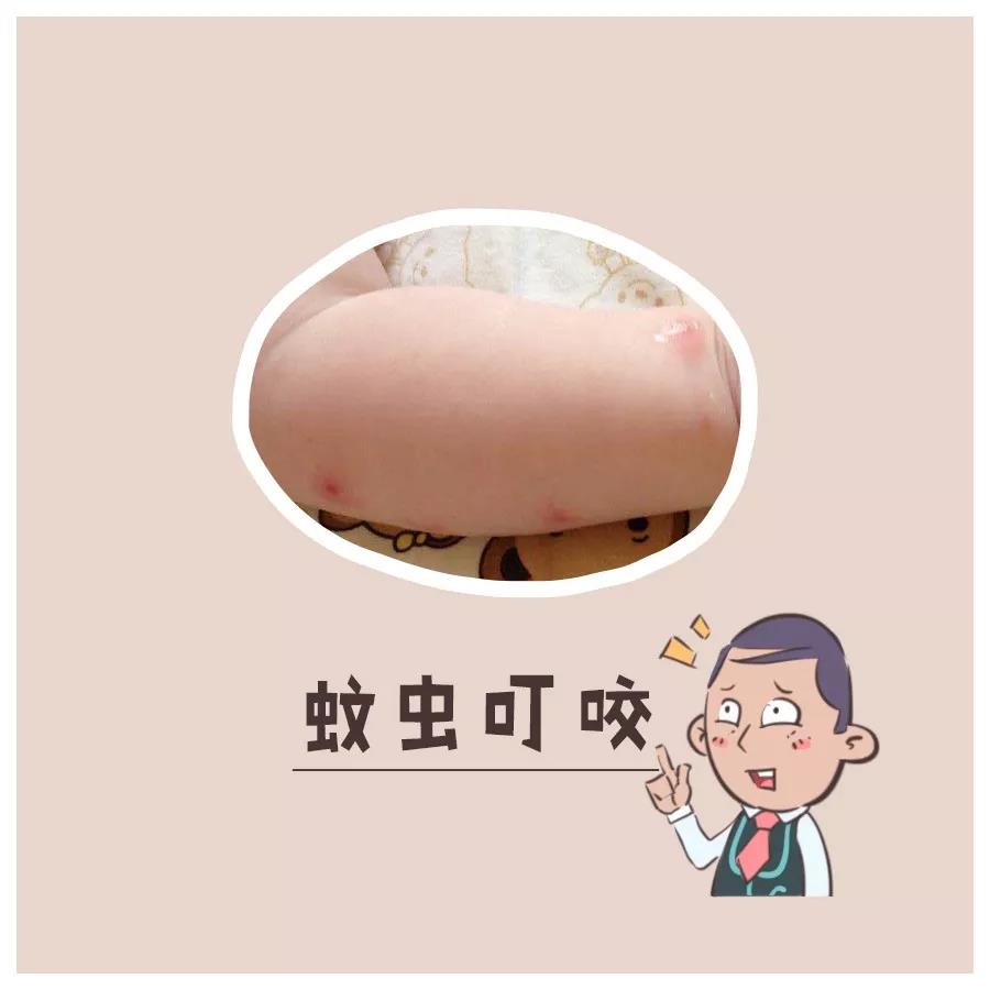 热天痱子怎么治,热天有痱子用什么最好