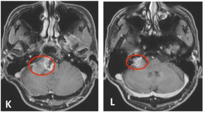 听神经瘤复发做二次手术,听神经瘤复发能要命吗
