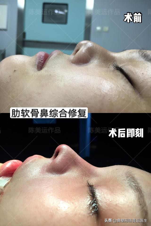 为什么医生都反对线雕隆鼻,到底要不要做线雕隆鼻