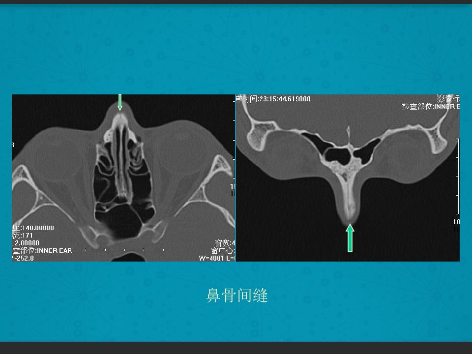 鼻骨骨折复位全过程,诊断证明鼻骨骨折问号是什么意思