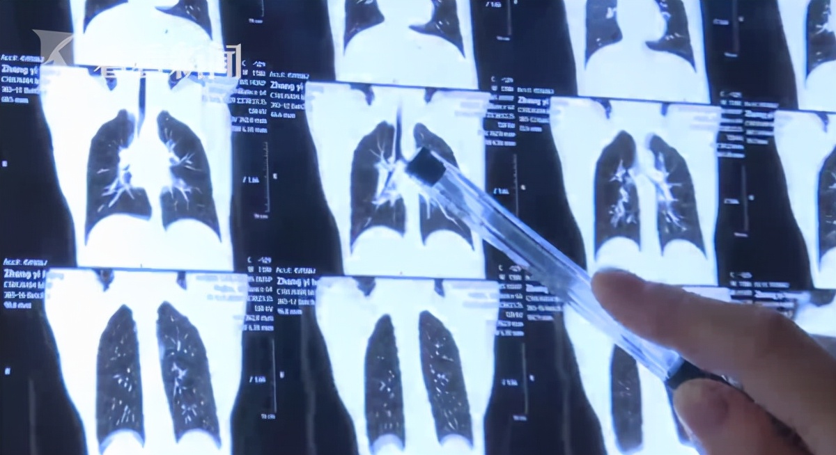 小孩气管发生异物时采用什么急救,10岁男孩口含图钉玩耍呛入气管