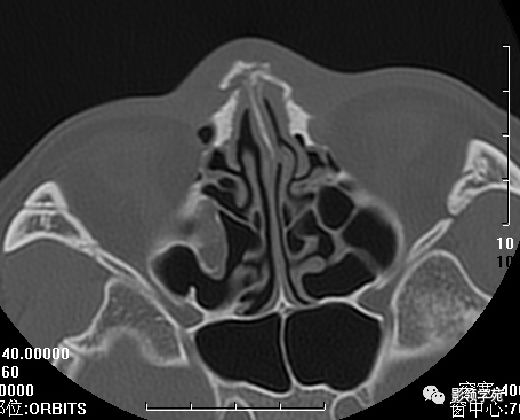 鼻骨影像学解剖,鼻骨解剖及骨折影像学诊断