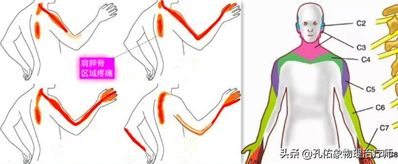 颈椎间盘突出手指尖麻乏力怎么治,颈椎间盘突出导致四肢无力疼痛