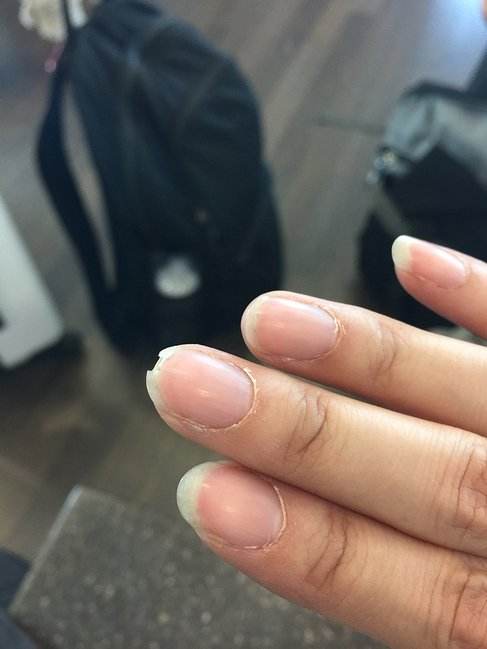 甲沟炎指甲盖劈了,为啥指甲盖劈着长