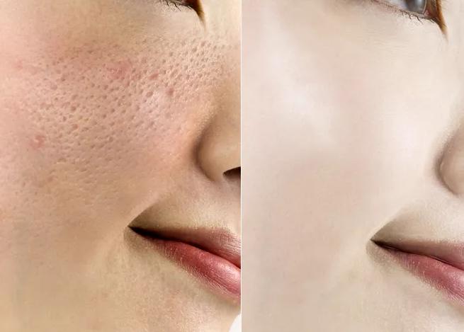 解决毛孔粗大的方法你学会了吗,教大家几招改善毛孔粗大的小技巧