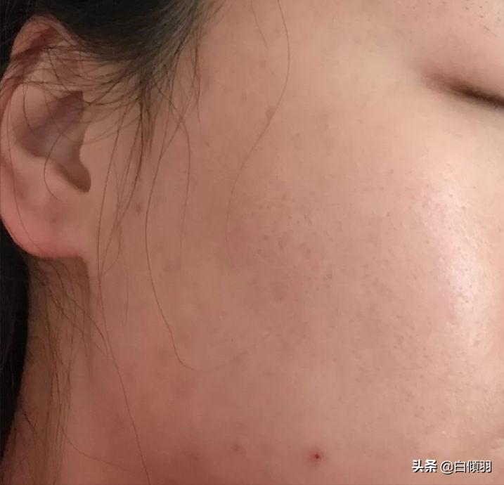 红肿痘痘不疼了但是还是有包,红肿痘痘摸着软软的一直不冒白头