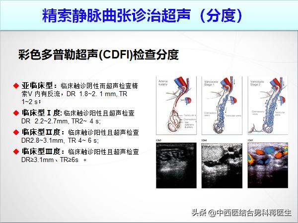 睾丸疼痛精索静脉曲张中医疗法,左侧睾丸静脉曲张多严重会不育