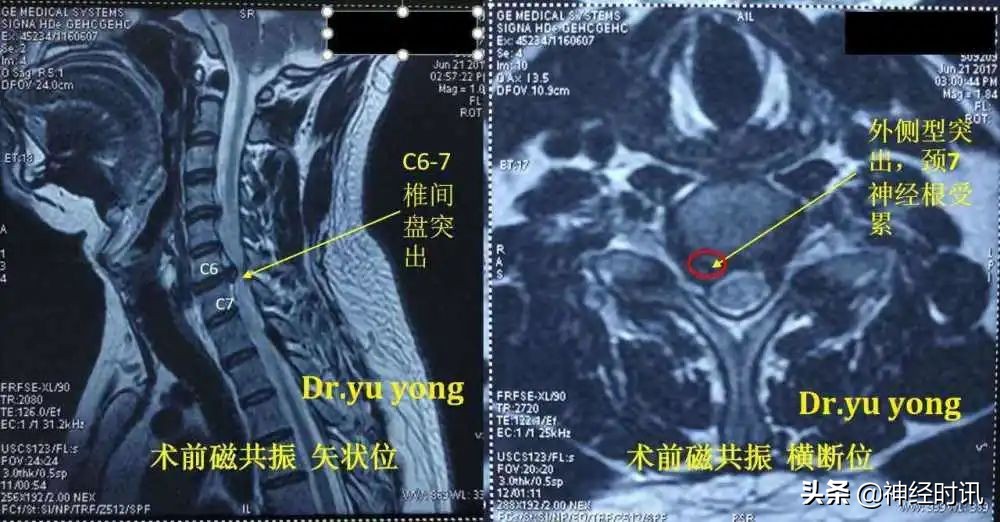 臀上神经卡压怎样松解教学视频,颈部神经卡压怎么自行恢复