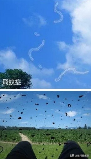 激光消融术治疗飞蚊症的亲身经历,眼睛飞蚊症怎么治疗用什么眼药水