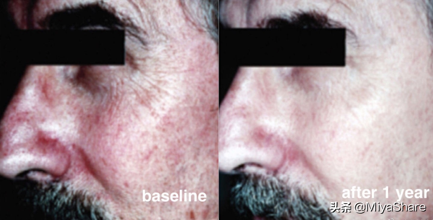 讲真,上了年纪维C精华真不能少!用和不用差别太大,看完就明白