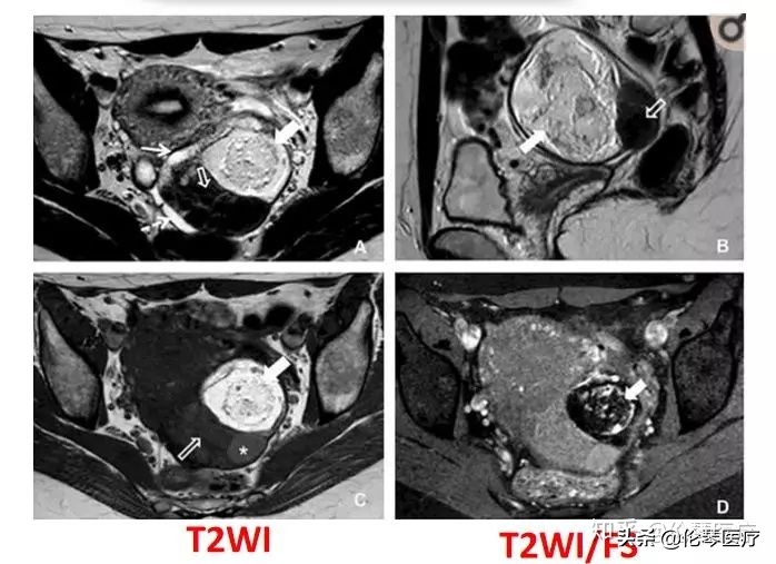 卵巢肿瘤核磁共振能看出来吗,超声测出来肿瘤