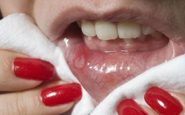 口腔溃疡补充维生素为什么,口腔溃疡补锌还是补维c