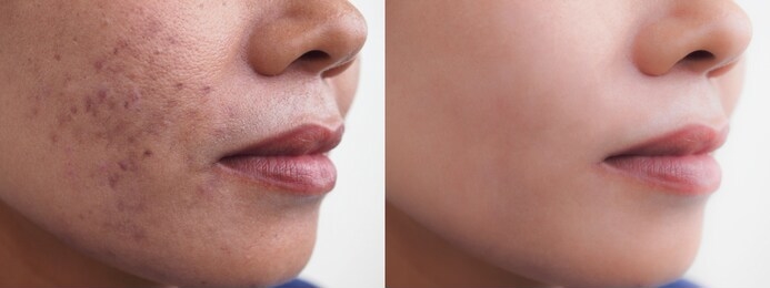 很久的痘印怎么去除最有效的方法,很明显的痘印怎么去掉