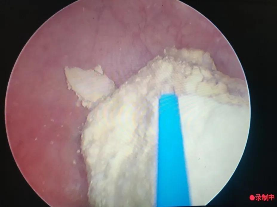 腹腔镜手术取节育环,节育环取出手术