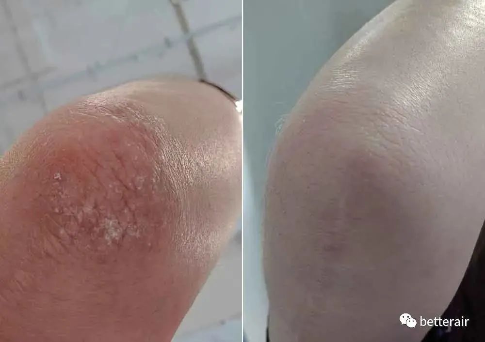 宝宝湿疹好了后一哭就变红,宝宝湿疹怕冷还是热