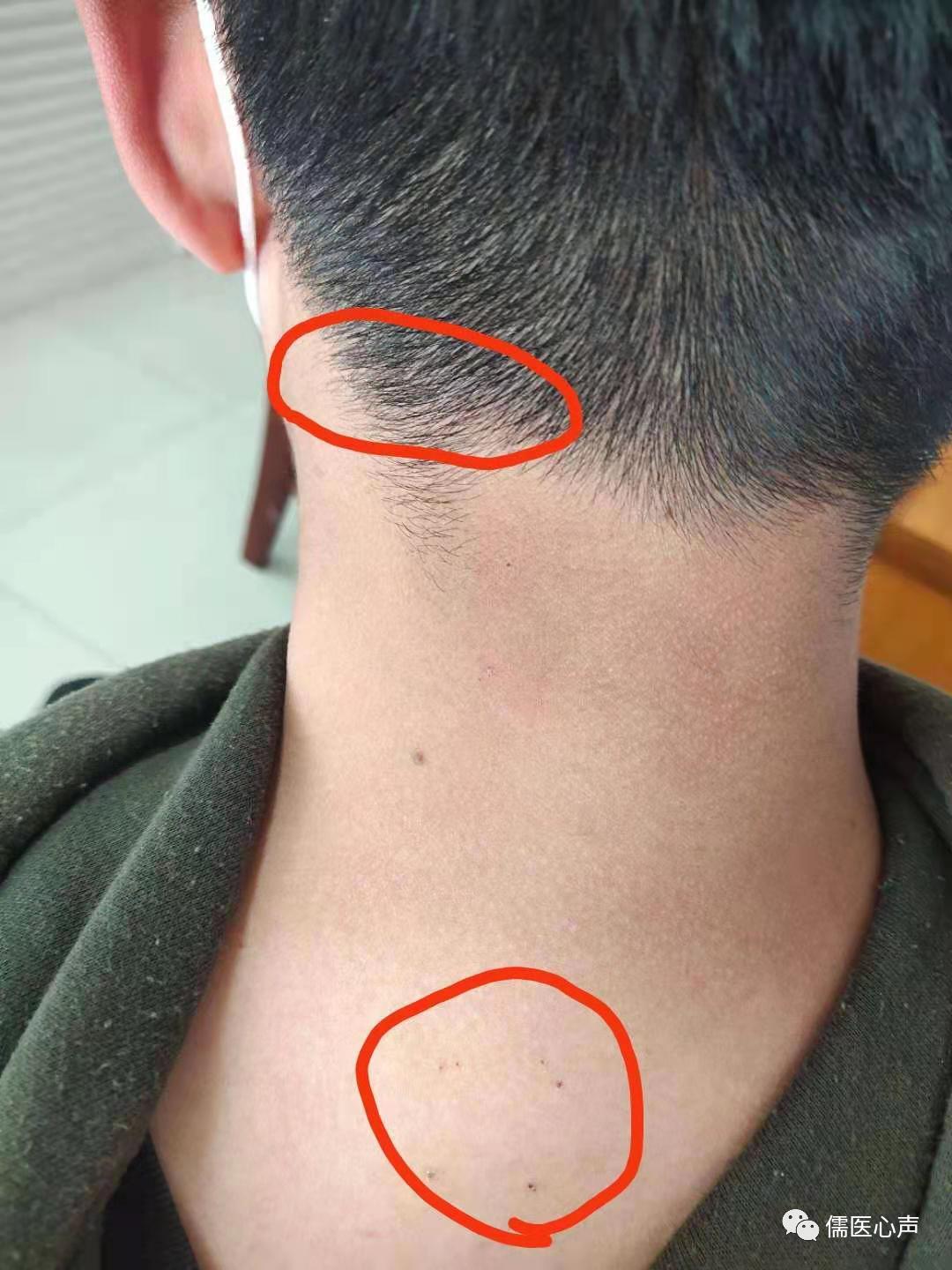 低头久了后脑勺疼怎么回事偏头痛,低头久了头晕可能是哪种大病