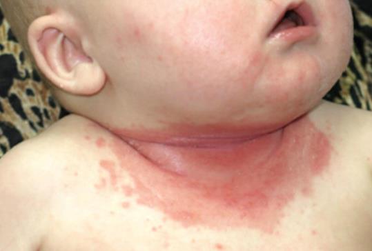 念珠菌皮肤病,常见皮肤病的诊断与治疗ppt