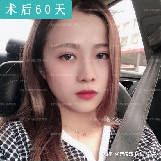 刚割双眼皮的样子,割双眼皮增生是什么样子